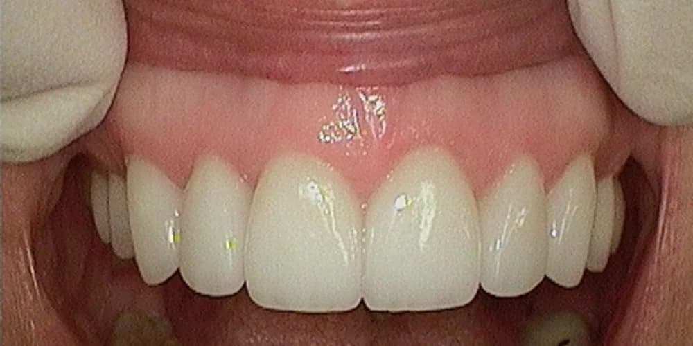 Nancy after smile makeover