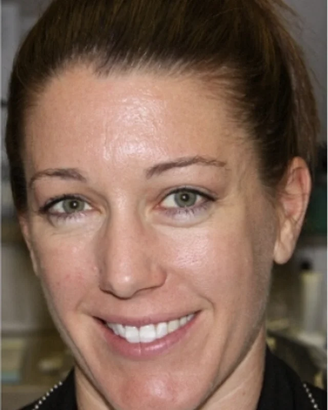 Shannon Motley before porcelain veneers