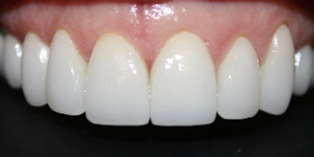 Shannon Motley after porcelain veneers