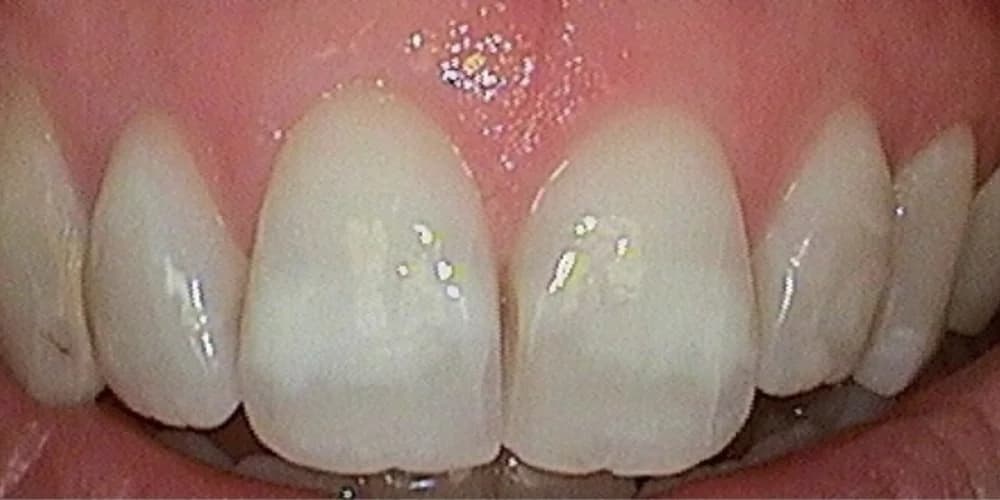 Shannon Motley before porcelain veneers