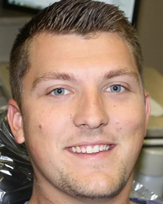 Skyler before porcelain veneers