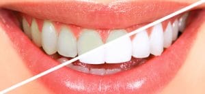 teeth-whitning1