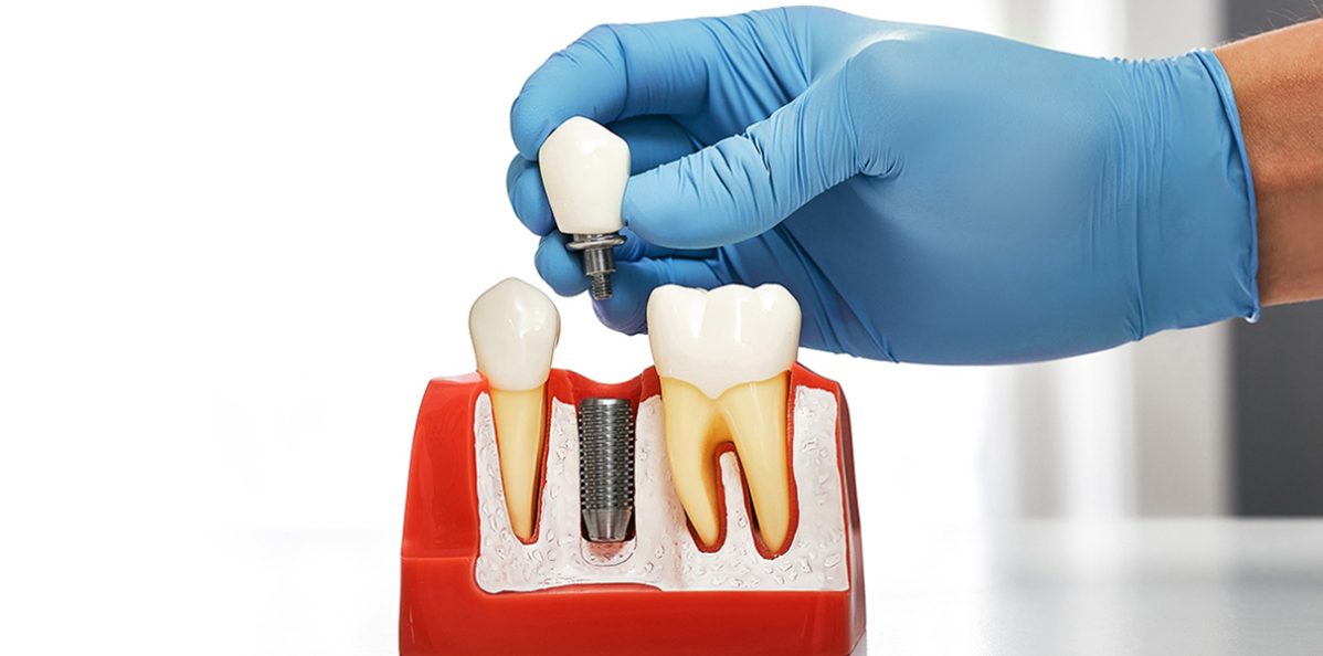 Dentists in Rocklin, CA, dental implants in Rocklin
