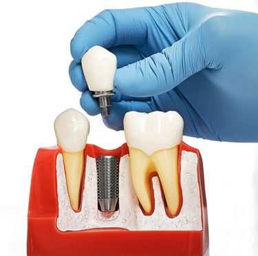 Dentists in Rocklin, CA, dental implants in Rocklin